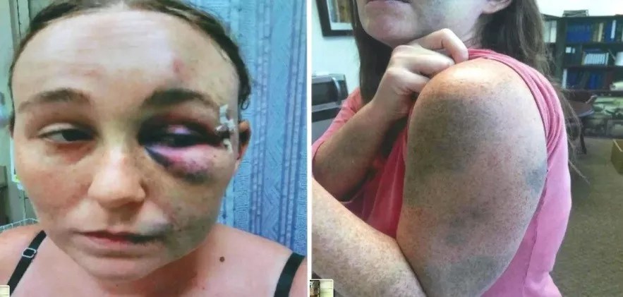 Woman Says Fort Lauderdale Cops Beat Her After She Testified in Brutality Case