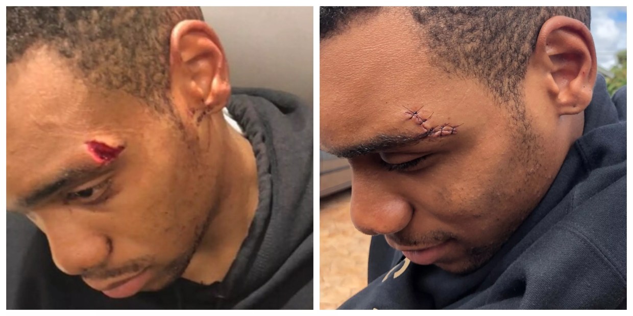 Another Black Teenager Accuses Broward Sheriff’s Office of Using Excessive Force