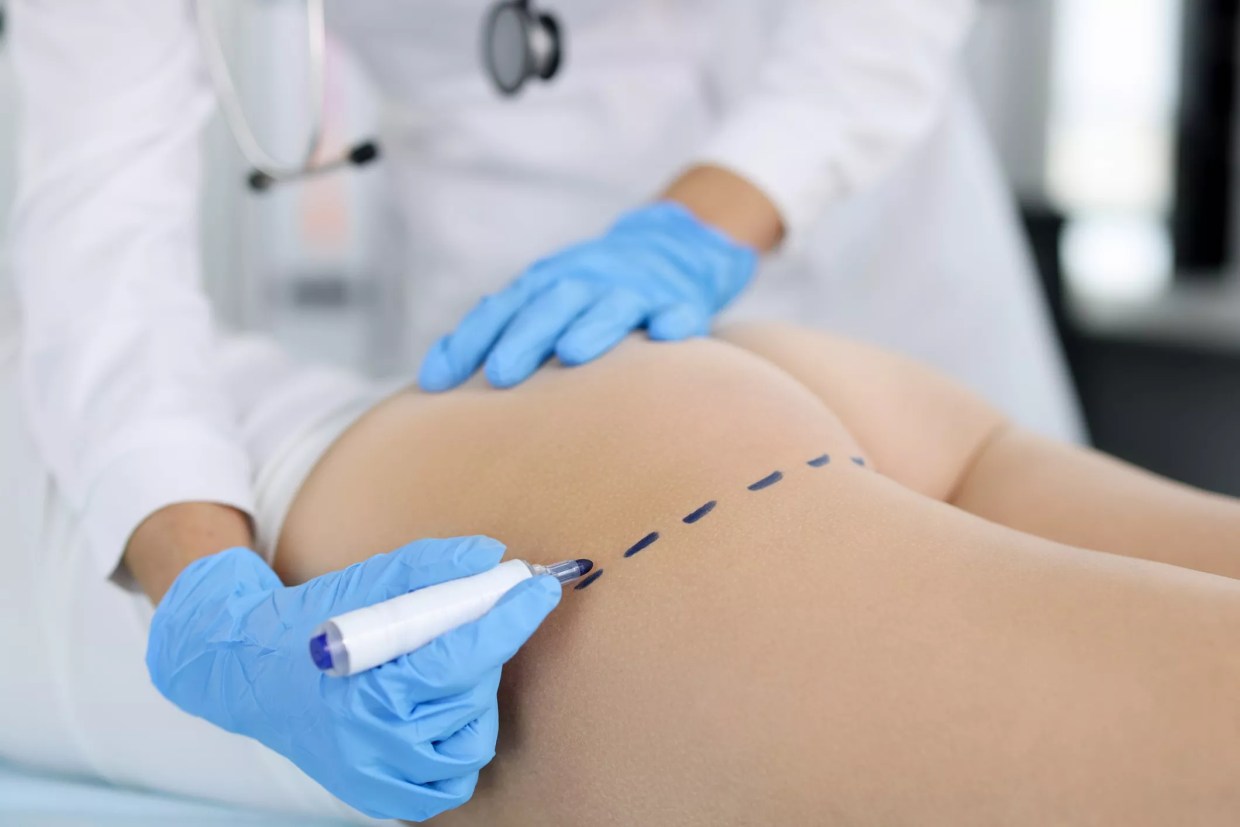 BBL Mecca: New Florida Law Aims to Curb Brazilian Butt Lift Deaths